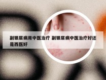 副银屑病用中医治疗 副银屑病中医治疗好还是西医好