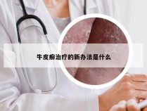 牛皮癣治疗的新办法是什么