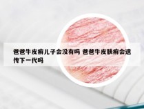 爸爸牛皮癣儿子会没有吗 爸爸牛皮肤癣会遗传下一代吗