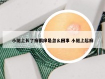 小腿上长了癣很痒是怎么回事 小腿上起癣