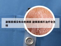 副银屑病没有白色鳞屑 副银屑病不治疗会怎样