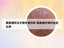 银屑病可以不擦外用药吗 银屑病不擦药会怎么样