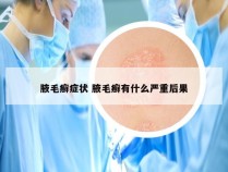 腋毛癣症状 腋毛癣有什么严重后果