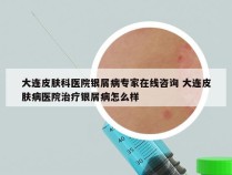 大连皮肤科医院银屑病专家在线咨询 大连皮肤病医院治疗银屑病怎么样