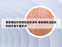 银屑病在热带地区会好点吗 银屑病生活在热的地方是不是好点