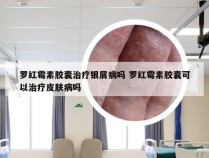 罗红霉素胶囊治疗银屑病吗 罗红霉素胶囊可以治疗皮肤病吗