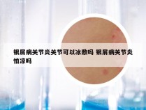 银屑病关节炎关节可以冰敷吗 银屑病关节炎怕凉吗