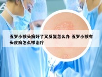 五岁小孩头癣好了又反复怎么办 五岁小孩有头皮癣怎么样治疗