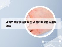 点滴型银屑影响性生活 点滴型银屑能抽烟喝酒吗