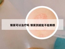 银屑可以治疗吗 银屑到底能不能断根