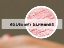 癣怎么看出快好了 怎么判断癣的类型