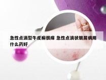 急性点滴型牛皮癣很痒 急性点滴状银屑病用什么药好