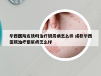 华西医院皮肤科治疗银屑病怎么样 成都华西医院治疗银屑病怎么样