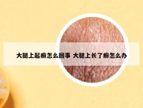 大腿上起癣怎么回事 大腿上长了癣怎么办