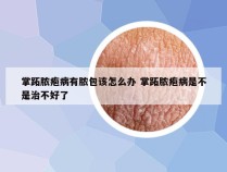 掌跖脓疱病有脓包该怎么办 掌跖脓疱病是不是治不好了