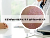 银屑病与血小板降低 银屑病导致血小板减少