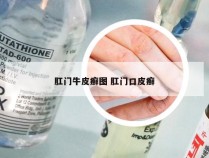 肛门牛皮癣图 肛门口皮癣