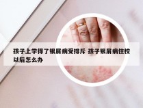 孩子上学得了银屑病受排斥 孩子银屑病住校以后怎么办