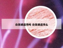 白斑病遗传吗 白斑病遗传么