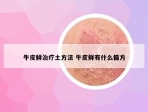 牛皮鲜治疗土方法 牛皮鲜有什么偏方