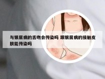 与银屑病的舌吻会传染吗 跟银屑病的接触皮肤能传染吗