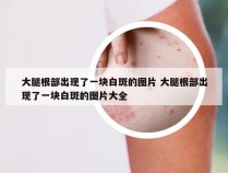 大腿根部出现了一块白斑的图片 大腿根部出现了一块白斑的图片大全