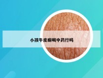 小孩牛皮癣喝中药行吗