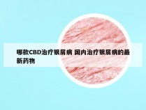 哪款CBD治疗银屑病 国内治疗银屑病的最新药物