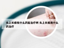 头上长癣有什么药能治疗啊 头上长癣用什么药治疗