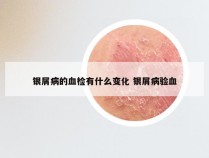 银屑病的血检有什么变化 银屑病验血