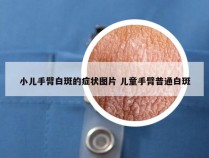 小儿手臂白斑的症状图片 儿童手臂普通白斑