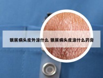 银屑病头皮外涂什么 银屑病头皮涂什么药膏