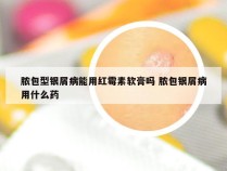 脓包型银屑病能用红霉素软膏吗 脓包银屑病用什么药