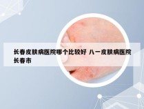 长春皮肤病医院哪个比较好 八一皮肤病医院长春市