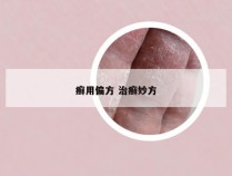 癣用偏方 治癣妙方