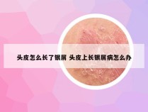 头皮怎么长了银屑 头皮上长银屑病怎么办