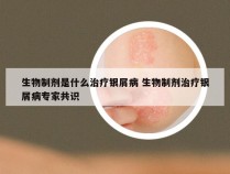 生物制剂是什么治疗银屑病 生物制剂治疗银屑病专家共识