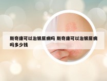 斯奇康可以治银屑病吗 斯奇康可以治银屑病吗多少钱