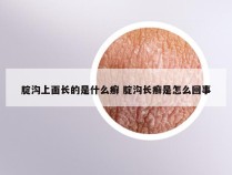 腚沟上面长的是什么癣 腚沟长癣是怎么回事