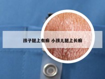 孩子腿上有癣 小孩儿腿上长癣