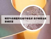 哪家牛皮癣医院在南宁排名好 南宁哪里治皮肤病厉害