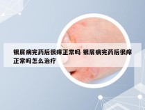 银屑病完药后很痒正常吗 银屑病完药后很痒正常吗怎么治疗