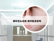 癣印怎么去除 藓印能自愈吗