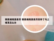 银屑病用激素药 银屑病用激素药膏停了马上爆发怎么办