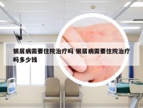 银屑病需要住院治疗吗 银屑病需要住院治疗吗多少钱