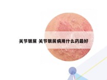 关节银屑 关节银屑病用什么药最好