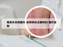 嘴角长白斑图片 白斑和白点癫风的 图片区别