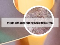 抗核抗体银屑病 抗核抗体银屑病能治好吗