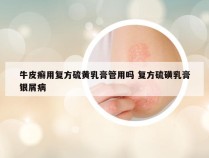 牛皮癣用复方硫黄乳膏管用吗 复方硫磺乳膏银屑病