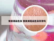 银屑病染色体 银屑病是染色体异常吗